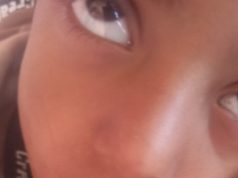 مناشدات عاجلة في الضالع جراء تفشي وباء “فطريات اللسان” بين أطفال منطقة تورصة