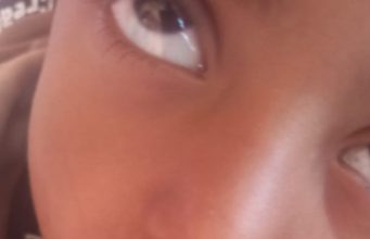 مناشدات عاجلة في الضالع جراء تفشي وباء “فطريات اللسان” بين أطفال منطقة تورصة