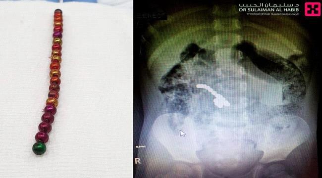 إنقاذ طفل ابتلع 21 كرة مغناطيسية